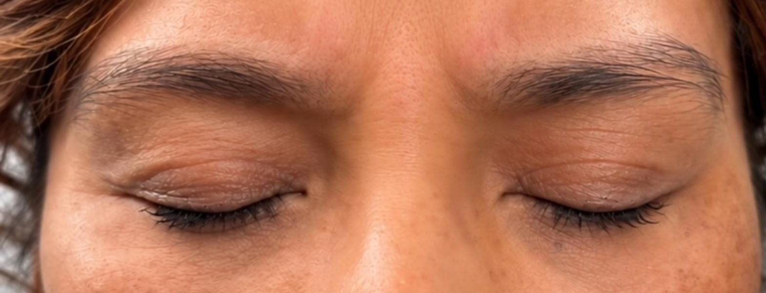 Close view of a client's relaxed brow and closed eyes after treatment at Everwell Luxe