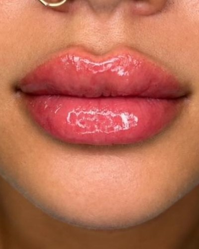 Client's lips after filler at Everwell Luxe