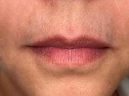 After: softened lines around the mouth