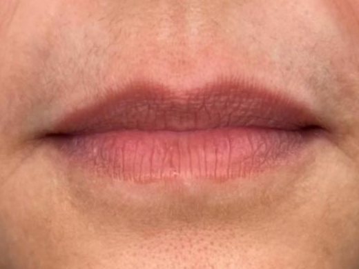 Before: lines around the mouth