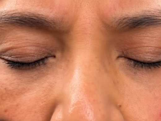 After: relaxed frown lines
