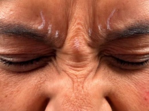 Before: frown lines when squinting