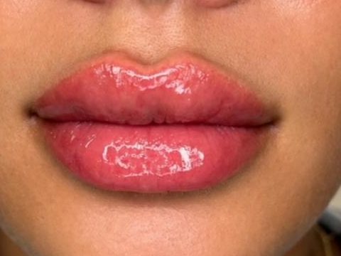After: fuller, defined lips